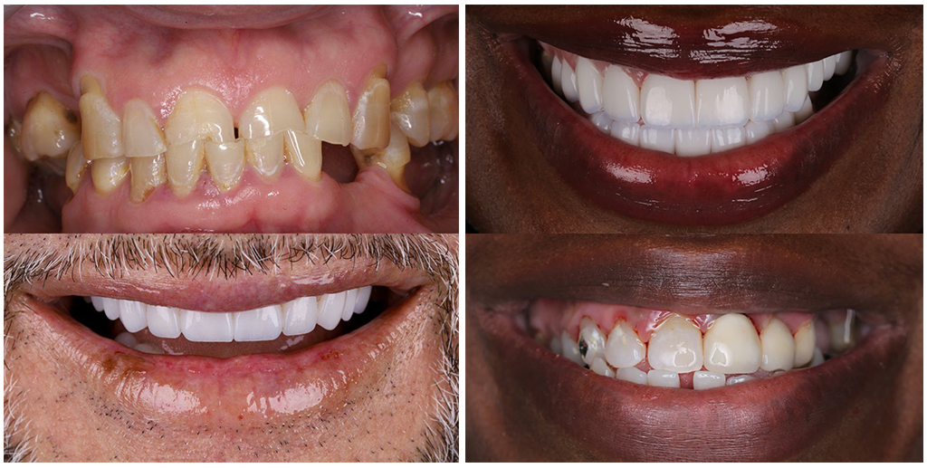 Cost of porcelain veneers in Colombia 2026 comparison chart